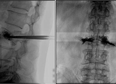 C臂機在打骨水泥時是怎么使用的(PKP手術記錄)
