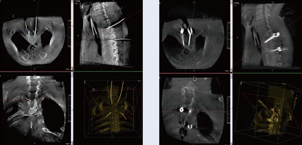 三維C臂與骨科導(dǎo)航機器人配合應(yīng)用(助力骨科手術(shù)更準確)