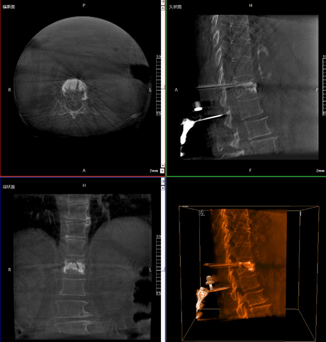 骨科機器人影像