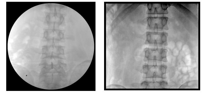 移動式平板C形臂X射線機(jī)腰椎圖像